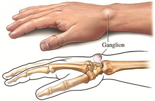 Ganglionzyste als Ursache für Schmerzen in den Händen und Gelenken
