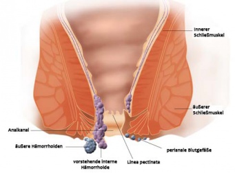 Hämorrhoiden – ganz alltäglich!