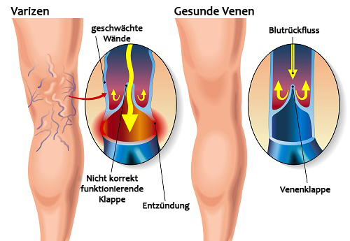 krampfadern