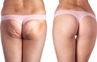 Natürliche Vorbeugung gegen Cellulite