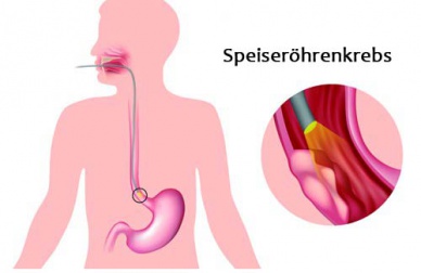 Erkrankungen der Speiseröhre - häufigste Symptome