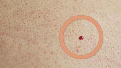 Rote Muttermale, was genau ist das?