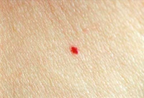 rote Muttermale