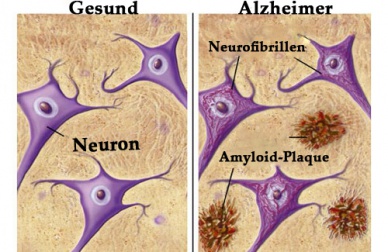 Lebensmittel die uns vor Alzheimer schützen