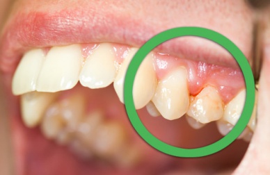 Natürliche Heilmittel gegen Zahnfleischbluten