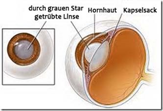 Grauer-Star-Erlaeuterung