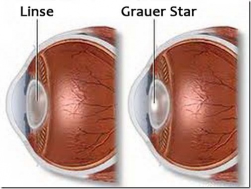 Linse-Grauer-Star