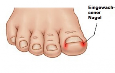 Wie kann man eingewachsene Nägel vermeiden?