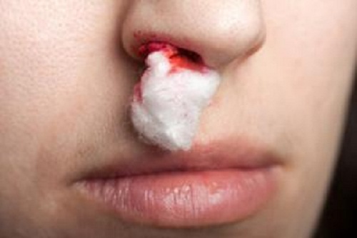 Wie kann man Nasenbluten stoppen?
