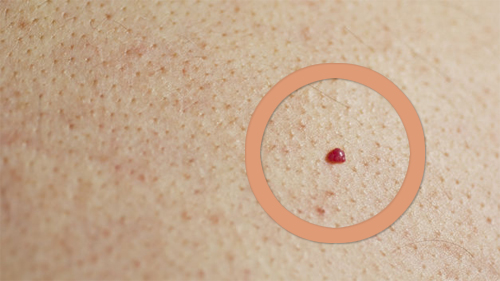 Warum erscheinen rote Muttermale auf der Haut Warum erscheinen rote Muttermale auf der Haut