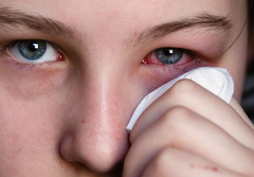Gerötete Augen sind schmerzhaft