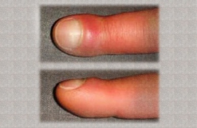Geschwollene Finger? Woran liegt das?