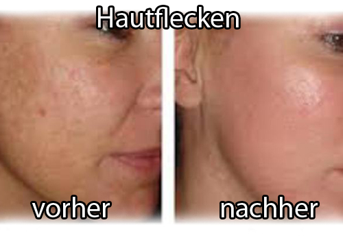 Hautfecken mit Apfelessig verbessern