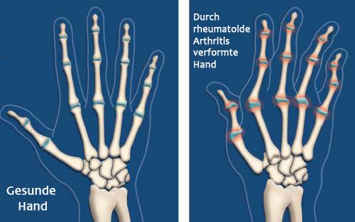 rheumatoide-arthritis