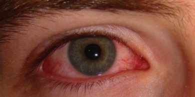 Gerötete Augen - Ursachen und einfache Hausmittel
