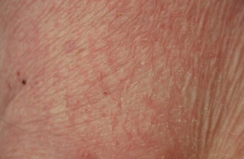 Trockene, stumpfe Haut: Ernähre dich richtig!