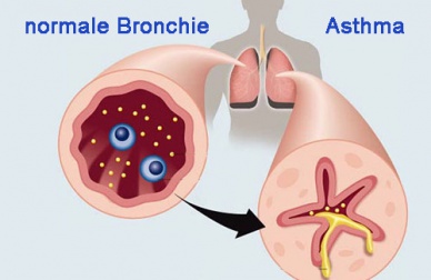 10 Nahrungsmittel gegen Asthma