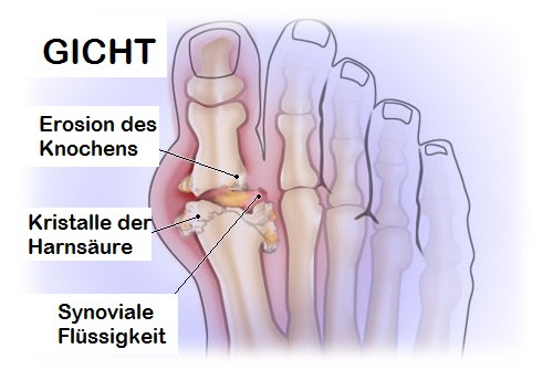 Was wirklich gegen Gicht helfen könnte