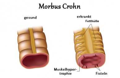 Morbus Crohn - Symptome und Behandlungsmethoden