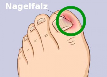 Was kann gegen Nagelfalze helfen?