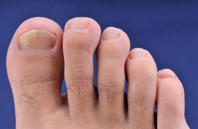 Naturheilmittel. die gegen Nagelpilz helfen könnten
