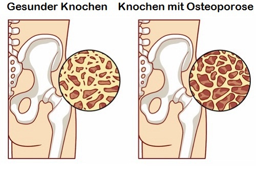 8 Lebensmittel zur Vorsorge gegen Osteoporose