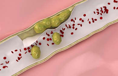 Naturheilmittel zur Reinigung der Arterien