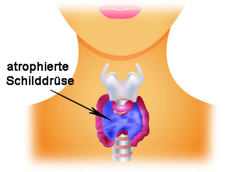 atrophierte-schilddrüse