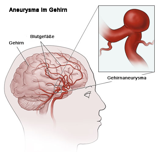 Was ist ein Aneurysma im Gehirn?