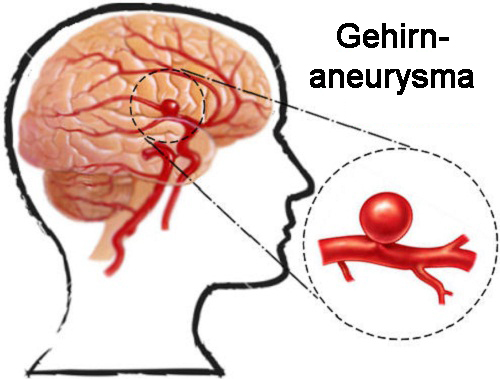 Aneurysma im Gehirn – Was ist das?