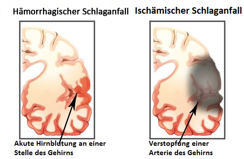 Schlaganfall