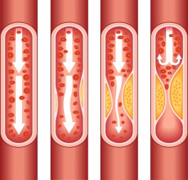 Entstehung und Vorbeugung von Thrombose