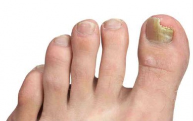 Tipps gegen Nagelpilz