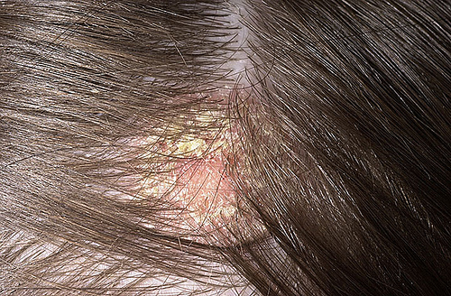 Dermatitis