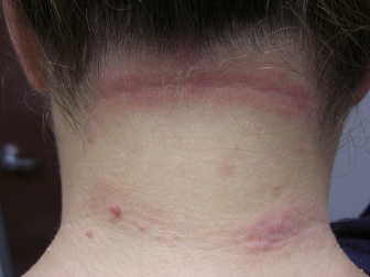 Seborrhoische Dermatitis - Behandlungsmöglichkeiten