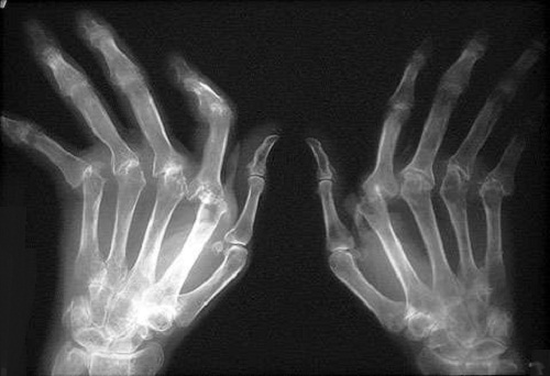 Natürliche Heilmethoden gegen rheumatoide Arthritis Natürliche Heilmethoden gegen rheumatoide Arthritis