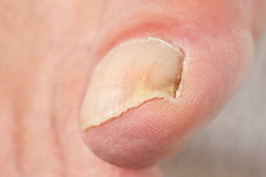Nagelkrankheiten - Ursachen und Behandlungsmöglichkeiten