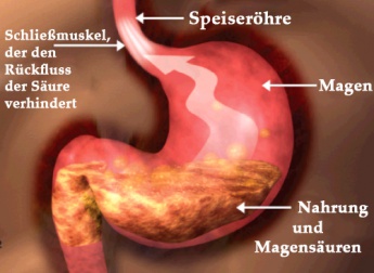 Die richtige Ernährung bei Reflux
