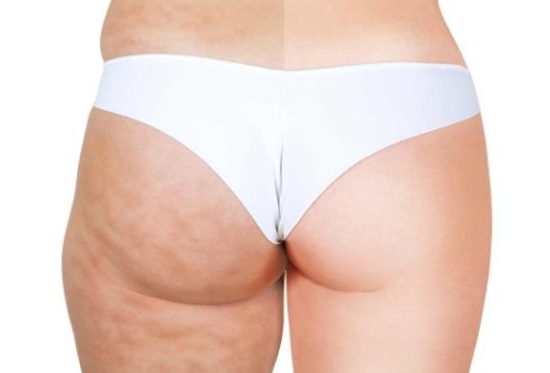 Massage gegen Cellulite