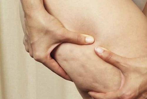 Einfache Tipps gegen Cellulite Einfache Tipps gegen Cellulite