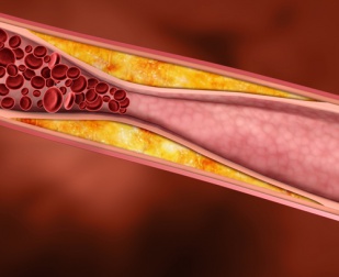 Heilpflanzen gegen einen erhöhten Cholesterinspiegel