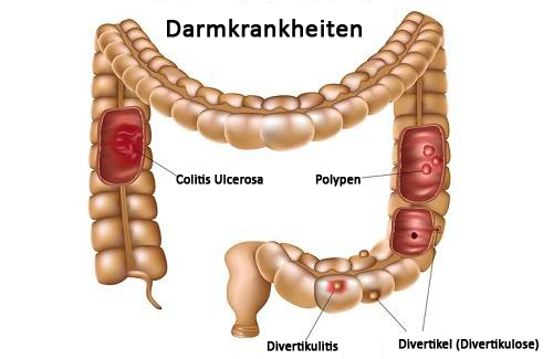 Hausmittel gegen Colitis Ulcerosa