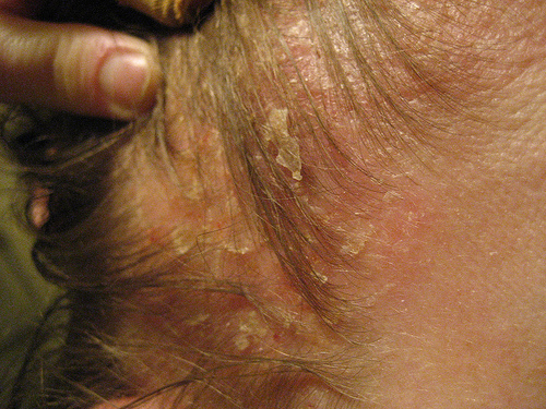 dermatitis-Kopf
