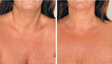 Tipps gegen Falten am Hals