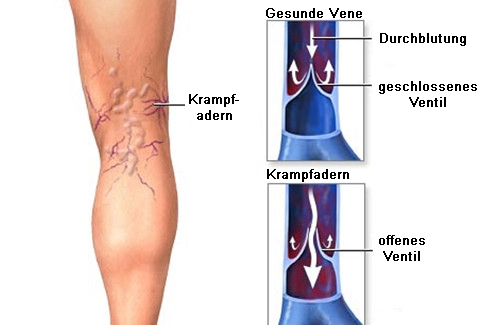 Krampfadern lindern mit einer kalten Dusche
