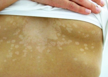 5 Veränderungen der Haut, die auf eine Krankheit hinweisen