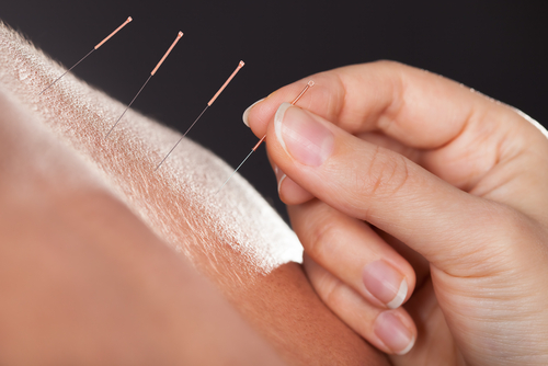 Akupunktur mit dünnen Nadeln