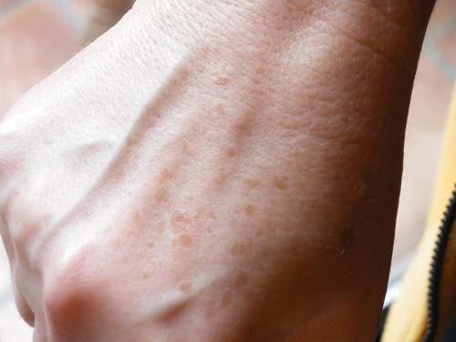 Hautpflege bei Altersflecken oder Sommersprossen