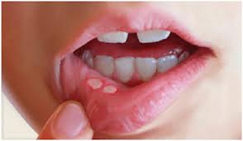 Ein geschwächtes Immunsystem verursacht Entzündungen im Mund