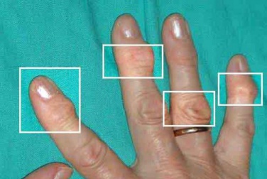 Natürliche Heilmittel bei Arthritis